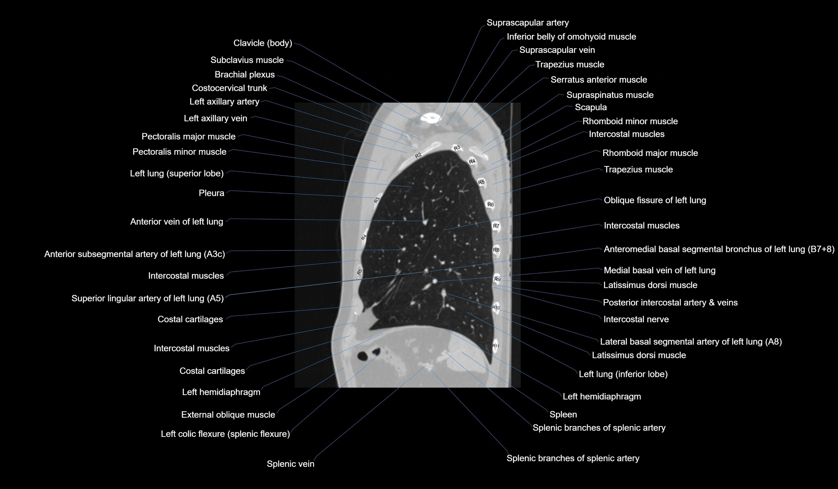CT chest (thorax) lung window labelled sagittal cross sectional anatomy radiology image-00110.webp